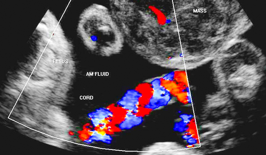 Viene eseguita una Flussimetria Materno Fetale presso Studio Vircos di Roma San Giovanni dal Dottor Giardina specialista in Ginecologia e Ostetricia