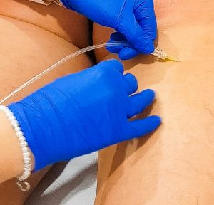 La Carbossiterapia eseguita dal nostro Medico Estetico perfezionato in medicina estetica a Roma