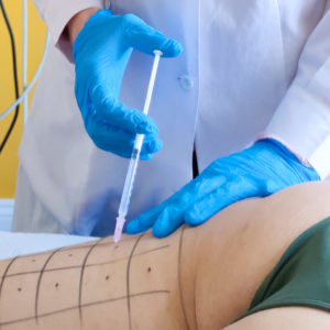 Uno dei nostri Medici Estetici esegue un trattamento di Mesoterapia per la cellulite