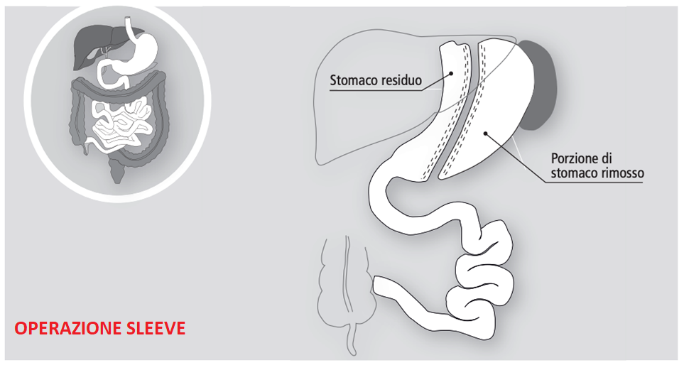 Chirurgia Bariatrica Roma